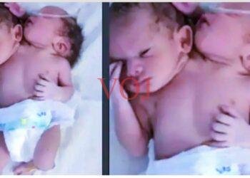 ವೈಧ್ಯಲೋಕಕ್ಕೆ ಅಚ್ಚರಿ ಮೂಡಿಸಿ ವಿಚಿತ್ರ ಮಗು ಜನನ: