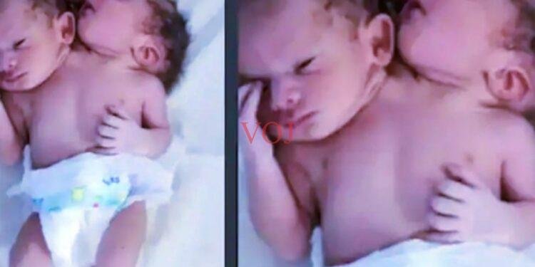 ವೈಧ್ಯಲೋಕಕ್ಕೆ ಅಚ್ಚರಿ ಮೂಡಿಸಿ ವಿಚಿತ್ರ ಮಗು ಜನನ: