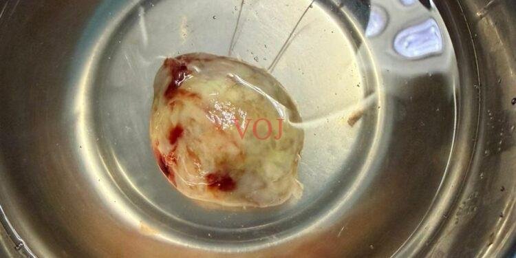 ಹೃದಯದಲ್ಲಿ ಬೆಳೆದಿದ್ದ ಸುಮಾತು 200 ಗ್ರಾಂ ತೂಕದ ಗಡ್ಡೆಯನ್ನು ಕೀಹೋಲ್ ಶಸ್ತ್ರ ಚಿಕಿತ್ಸೆಯ ಮೂಲಕ ಯಶಸ್ವಿಯಾಗಿ ಹೊರ ತೆಗೆದ:ಎಂಡೊಸ್ಕೋಪಿಕ್ ಶಸ್ತ್ರಚಿಕಿತ್ಸಕ ಡಾ. ರವಿ ಘಟ್ನಟ್ಟಿ